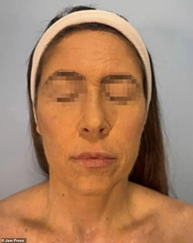 Woman Suffers Severe Burns from Rare Reaction to Common Mental Health Drug